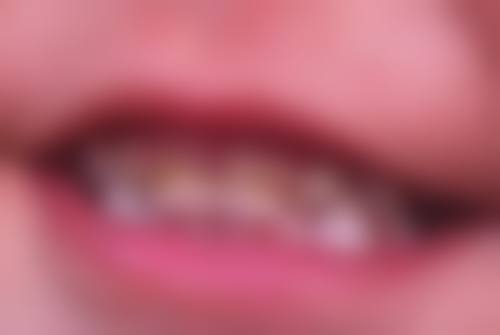洗牙对牙齿健康有什么好处