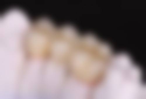 拔牙后不镶牙会加重关节负担吗