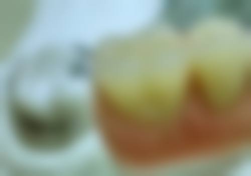 种植牙和全口假牙在稳固性上哪个好?