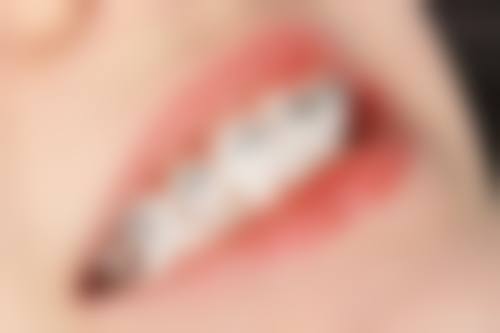 成人树脂补牙的优势与适用人群深度解析