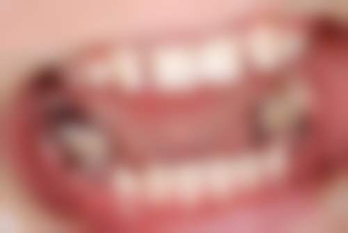 小孩能拔牙齿有影响吗?正规操作无隐患,及时就诊护恒牙,家长别慌快收藏!